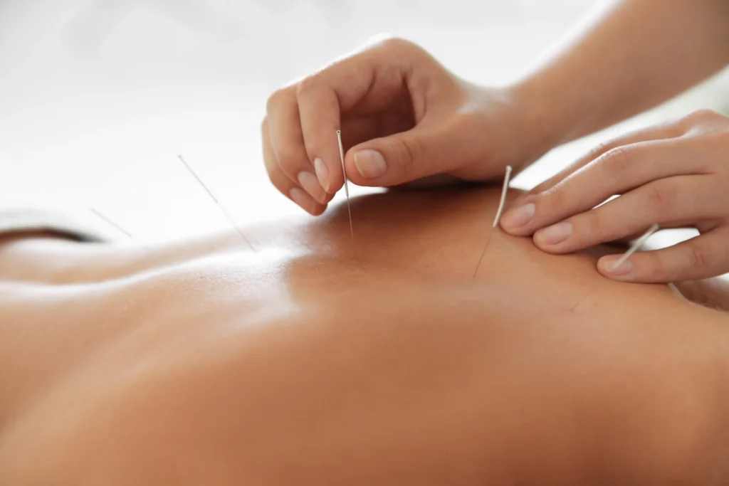 acupuncture treatment on woman s back for health 2026 03 05 11 41 29 utc