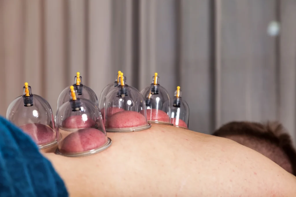 cupping therapy treatment on person s back 2026 03 24 02 02 59 utc