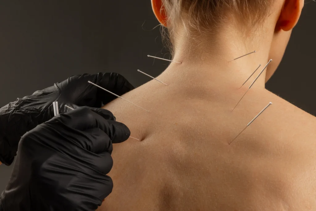 professional acupuncture session on upper back cl 2026 03 25 08 19 56 utc