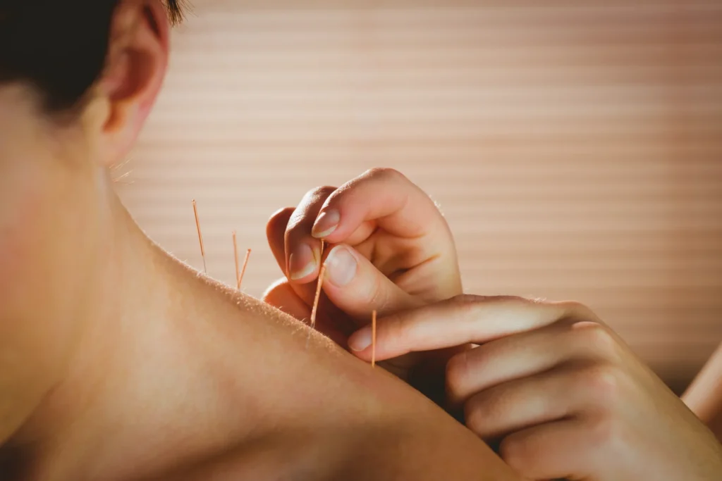 Services 3 receiving acupuncture treatment for neck and shoul 2026 01 09 11 36 20 utc