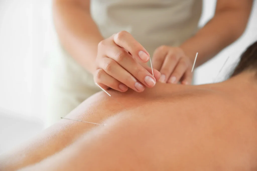 relaxing acupuncture session for health and wellne 2026 03 27 02 11 38 utc